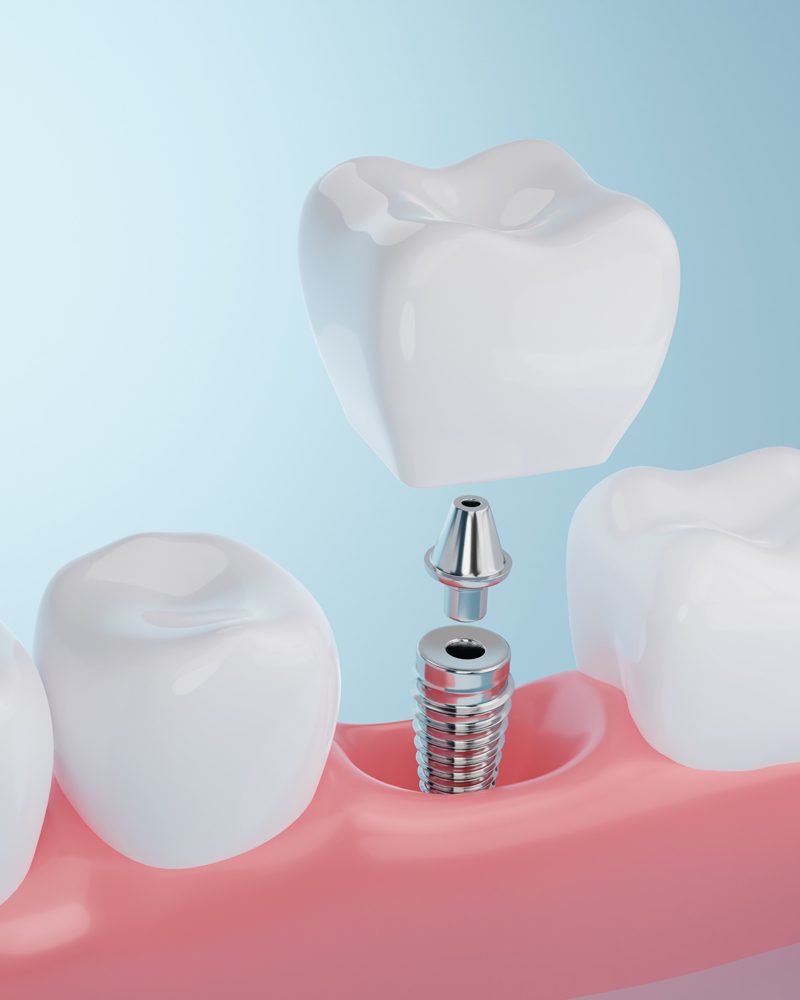 Dental implant procedures in Jacksonville, FL near Mandarin
