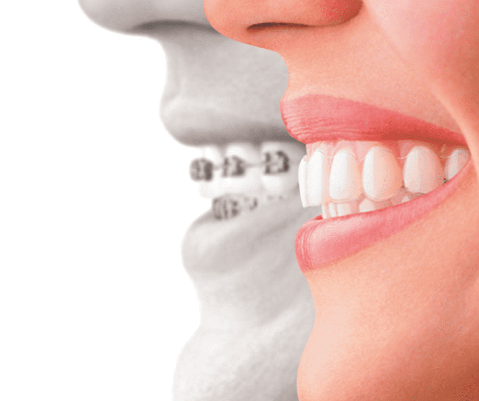 Invisalign | Orthodontic Treatment in Jacksonville, FL
